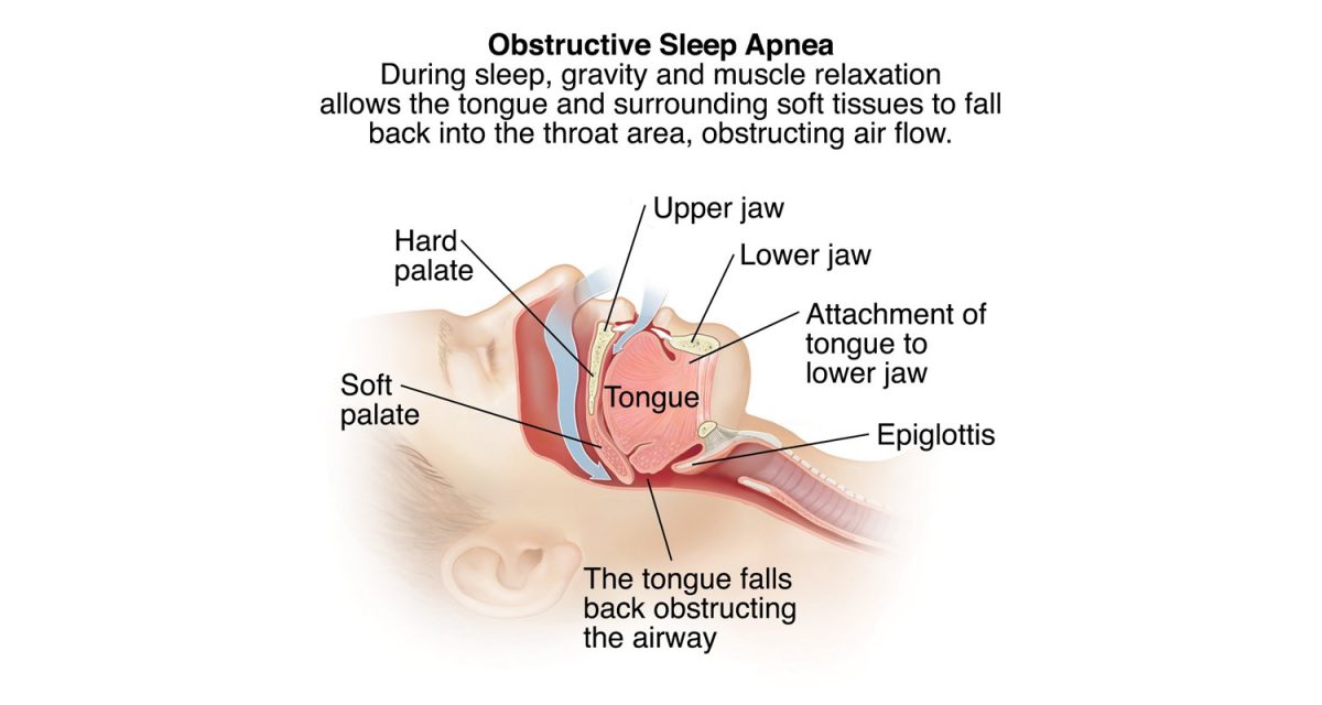 obstructive_sleep_apnea_hr